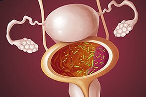 Cystite bactérienne chez une femme.