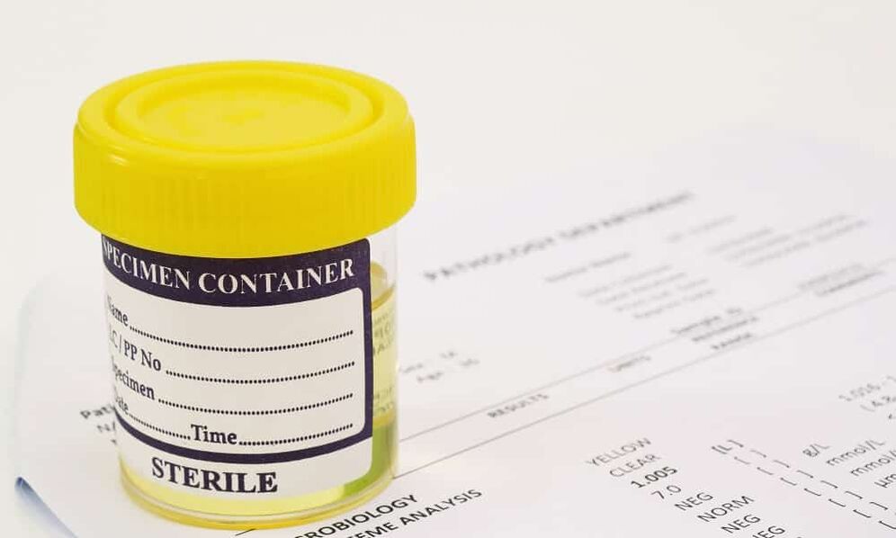 Vous devriez faire un test d'urine avant de prendre des antibiotiques.